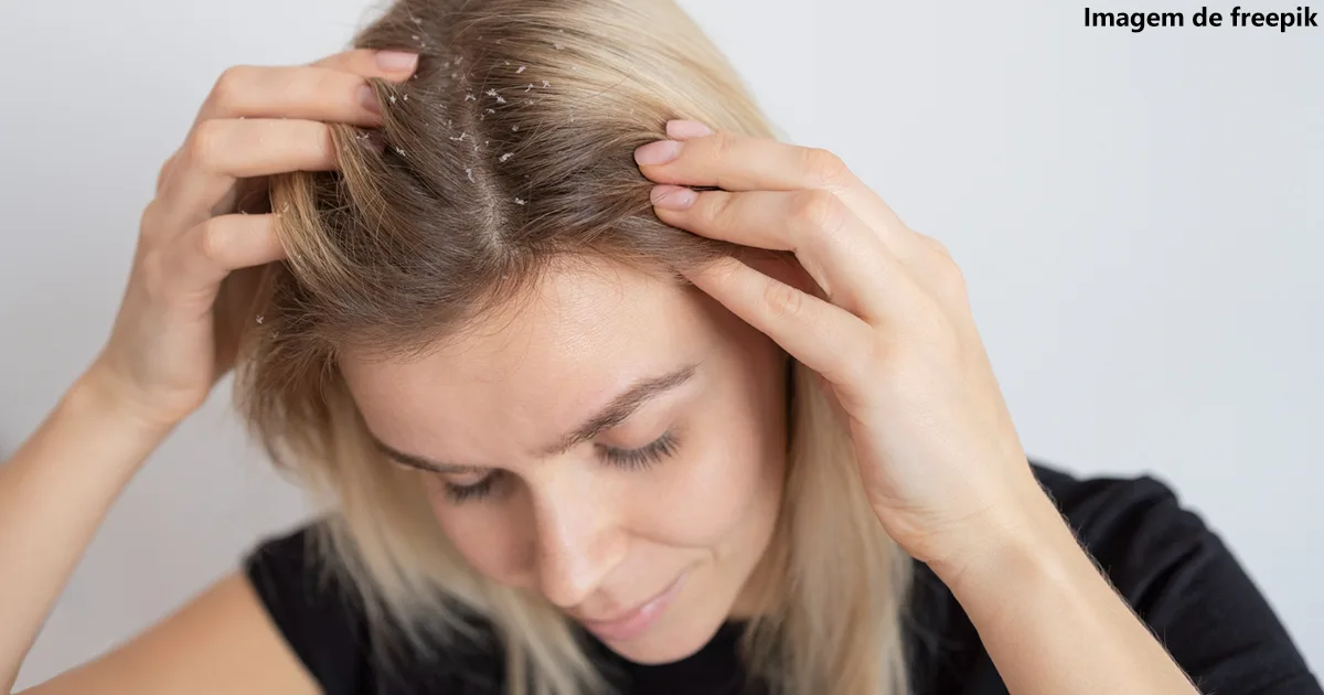 Como Eliminar a Caspa de Vez Como Eliminar a Caspa de Vez